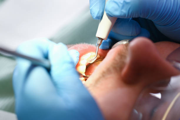 Best Emergency Dental Care for Broken or Chipped Teeth in Blue Grass, IA